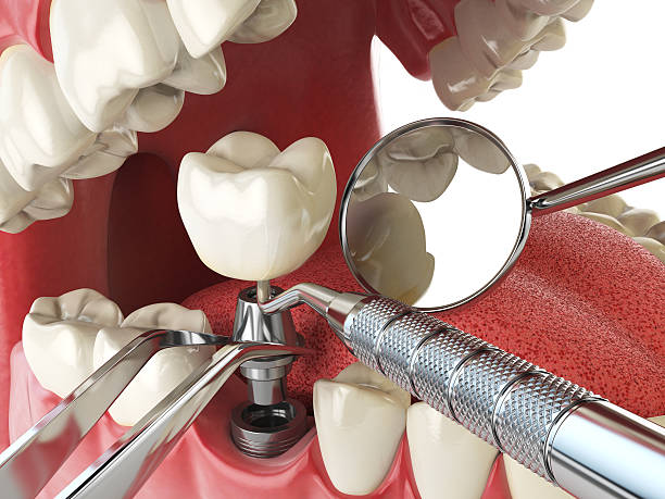 Best Emergency Denture Repair in Los Banos, CA